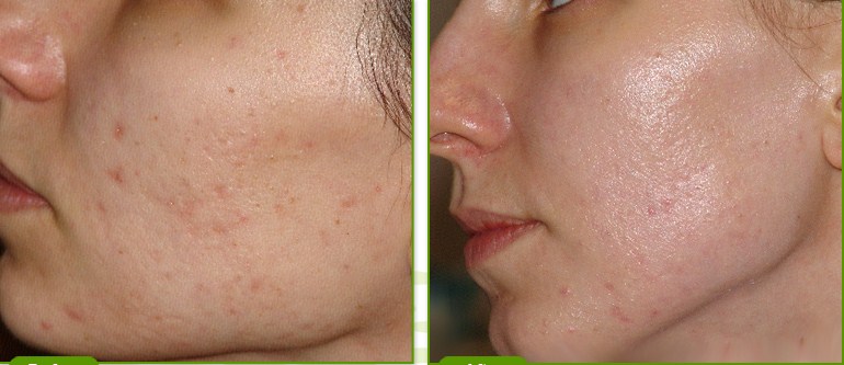 acne ar behandling københavn acne ar behandling københavn